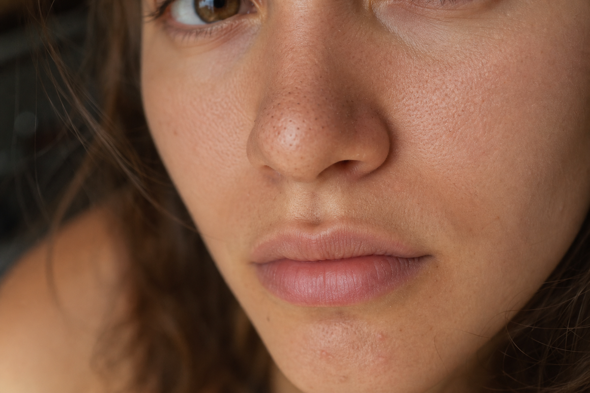 Junge Frau mit sichtbaren tiefsitzenden Mitessern im Bereich der Nase und Poren